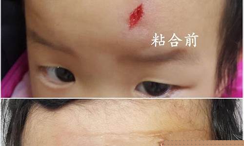 头部受伤流血可以喝花胶汤吗为什么-头部受伤流血可以吃鸡蛋吗